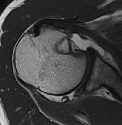 Posterior Shoulder Dislocation